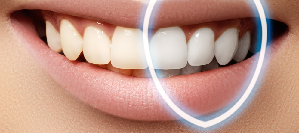 Diş Beyazlatma Nedir ? Diş Beyazlatma Nasıl Yapılır ? | Minepol