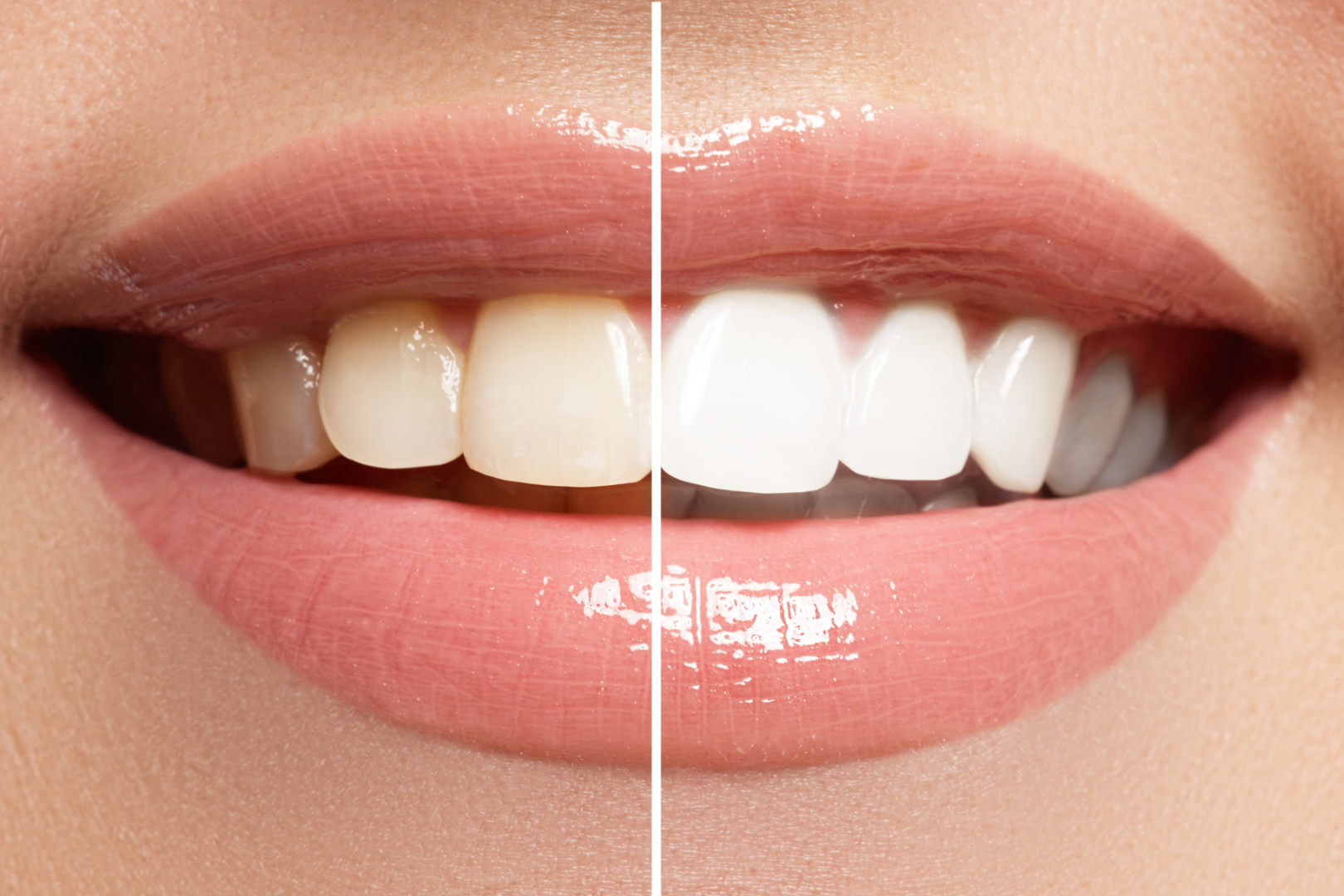 Diş Beyazlatma Trendleri  | Minepol